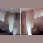 யாழில் தொடர்ந்து அச்சுறுத்தும் பாதிப்பு – தீவிர ஆராய்ச்சியில் அதிகாரிகள்